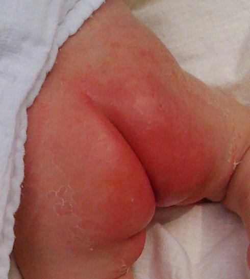 diaper dermatitis treatment